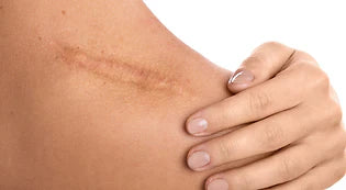 החלמת צלקות בדרך טבעית