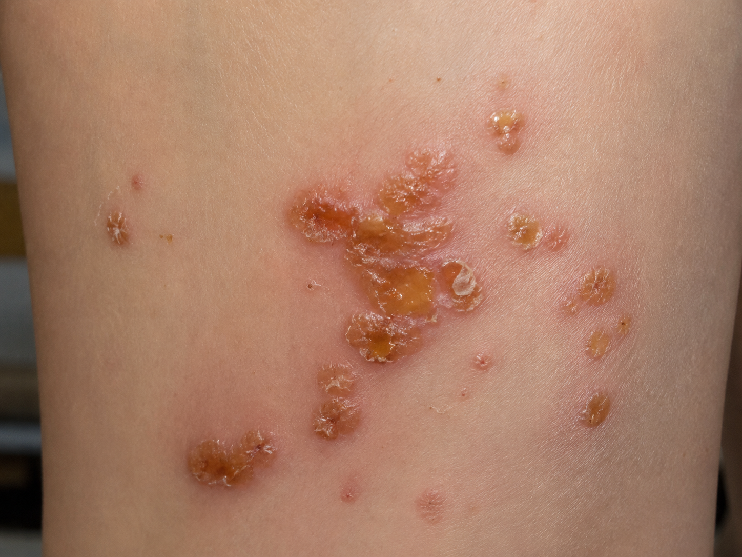 אמפטיגו (גלדת) בילדים - איך מטפלים בצורה טבעית ויעילה
