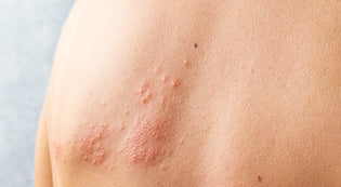 טיפול טבעי באטופיק דרמטיטס